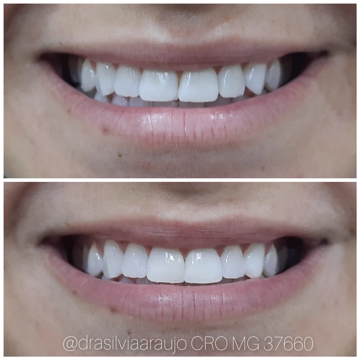 Sorriso 1 — antes e depois