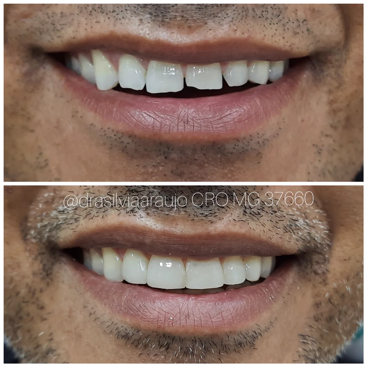 Sorriso 2 — antes e depois