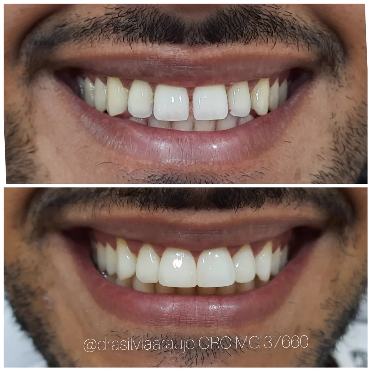 Sorriso 3 — antes e depois