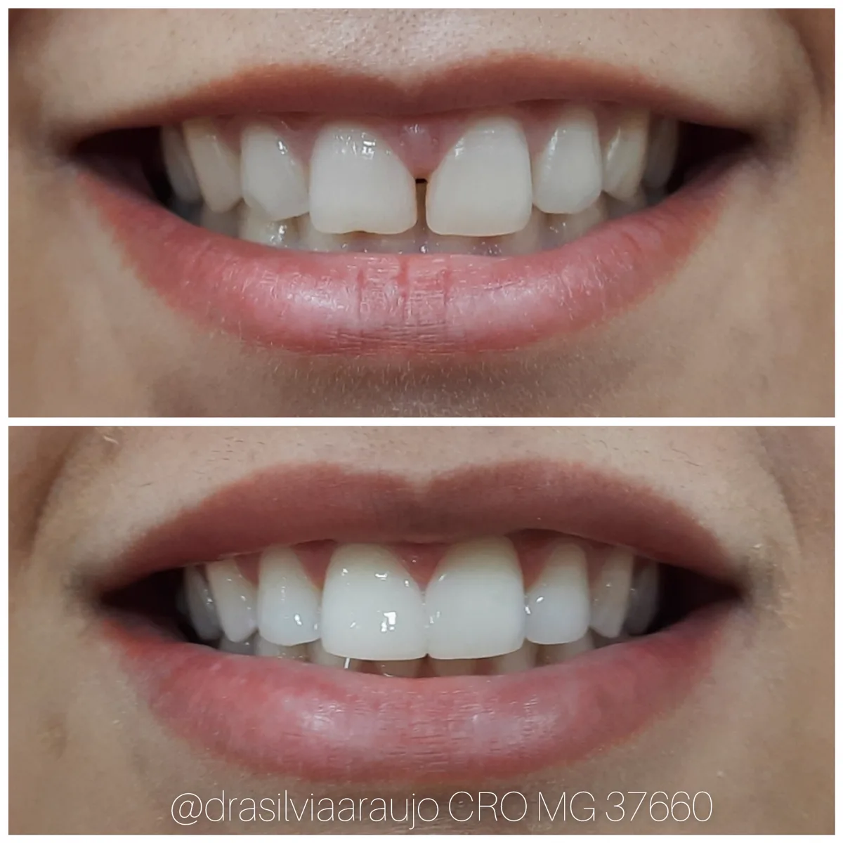 Sorriso 4 — antes e depois