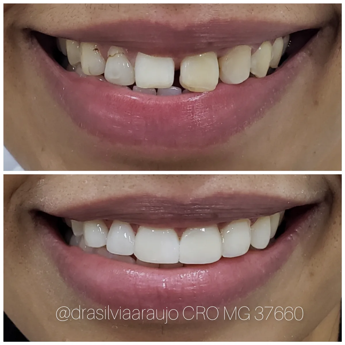 Sorriso 5 — antes e depois