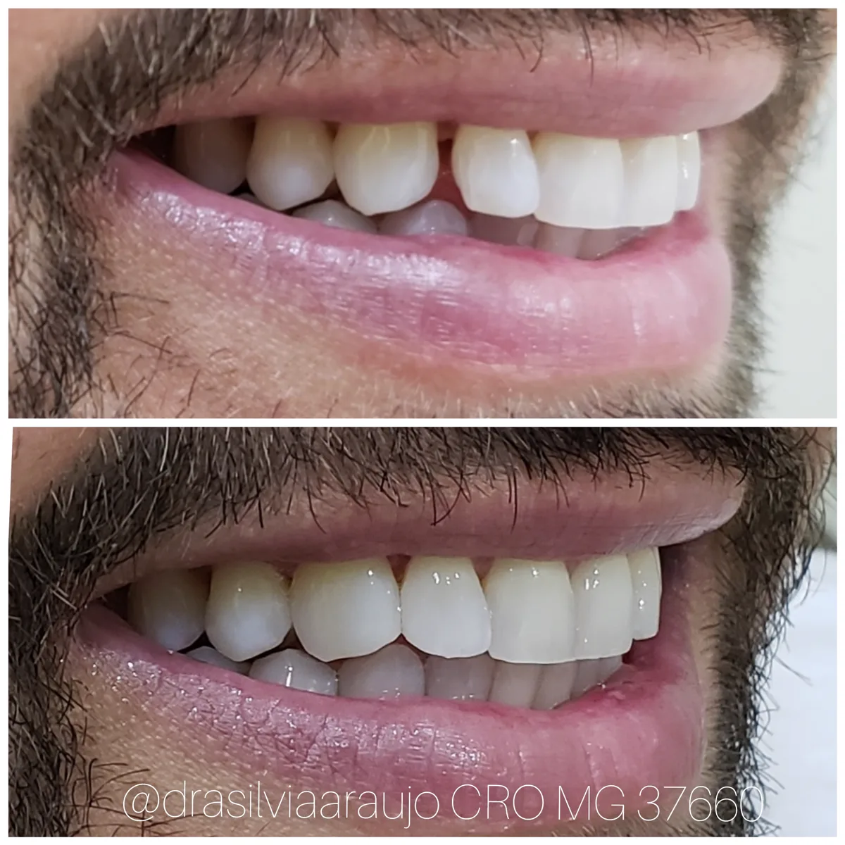 Sorriso 6 — antes e depois